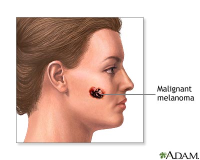 malignant melanoma Kanker Kulit