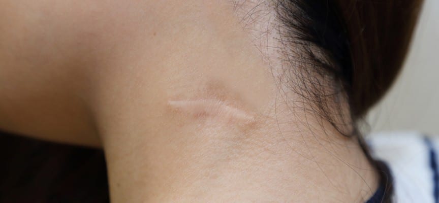 Kenali Keloid Atau Scar Tissue | Informasi Kesehatan dan Tips Kesehatan ...