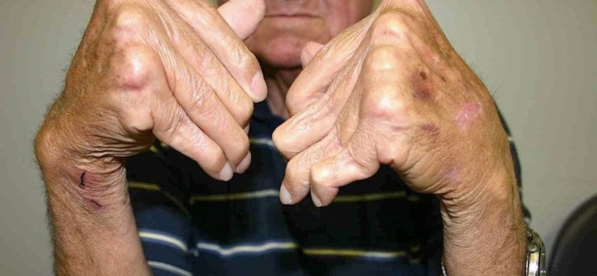doktersehat- Rhematoid-Arthritis-tangan