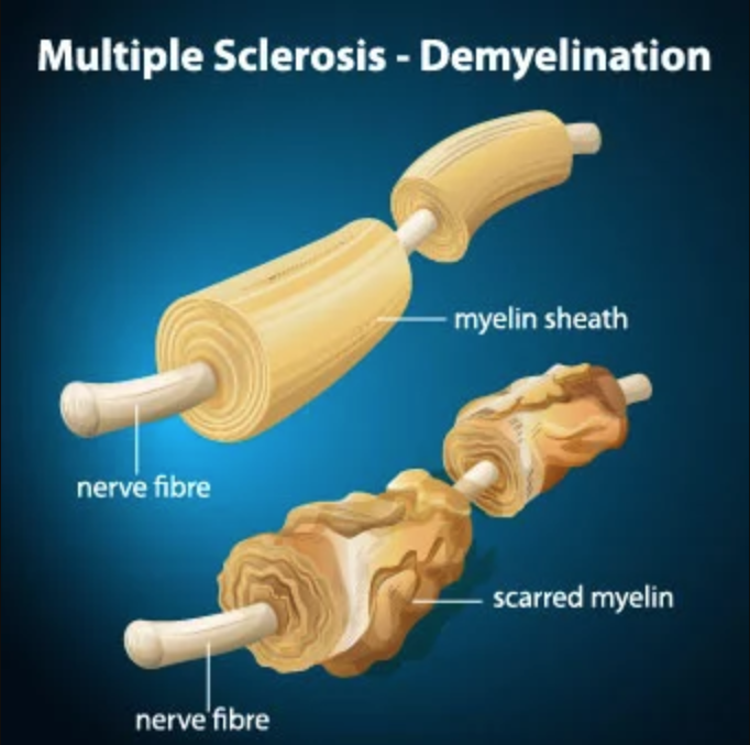 mielin-multiple-sclerosis-doktersehat