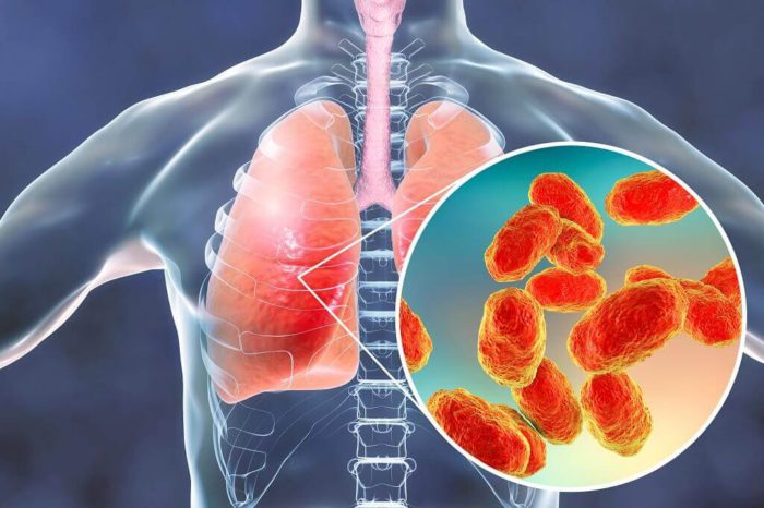 Pneumonia Penyebab Gejala Diagnosis Dan Pengobatan