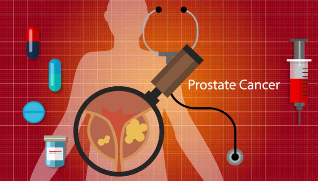 Kanker Prostat: Penyebab, Gejala, Diagnosis dan Pengobatan