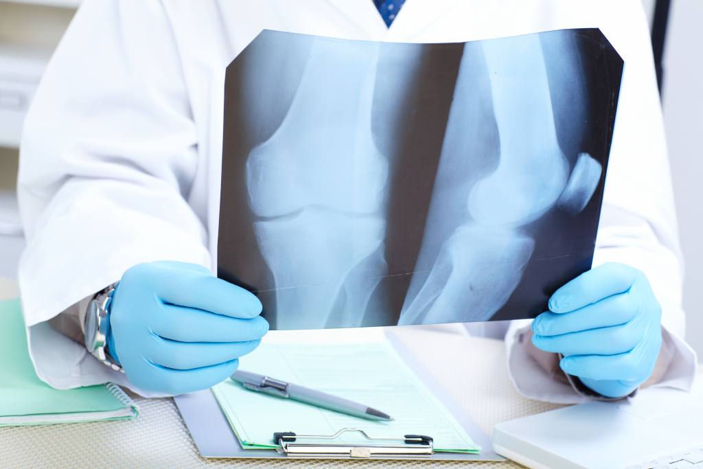 Kanker Tulang: Penyebab, Gejala, Diagnosis, dan Pengobatan
