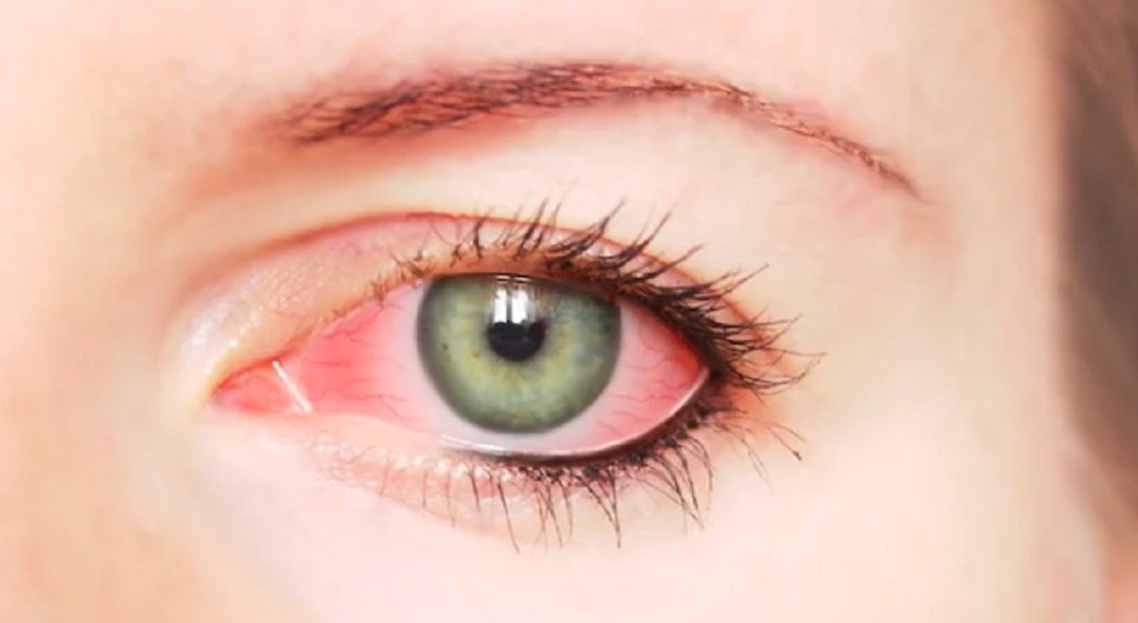 10 Penyebab Mata Merah, dari yang Ringan hingga Serius