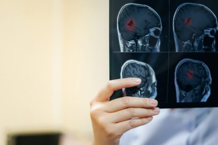 multiple-sclerosis-doktersehat