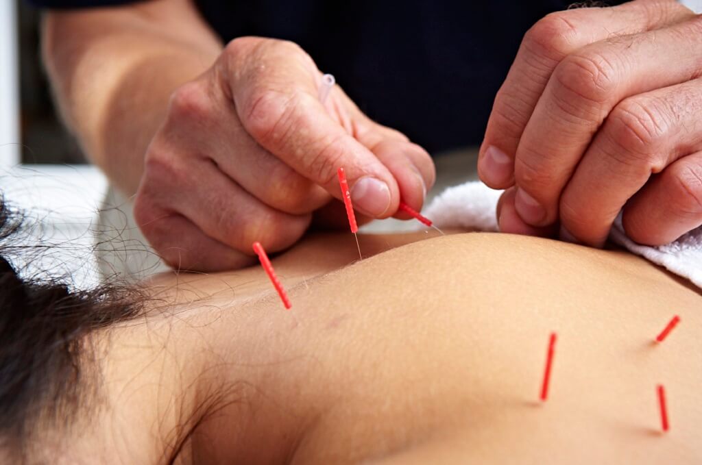Akupunktur: Teknik Menusuk Kulit untuk Menyembuhkan Penyakit