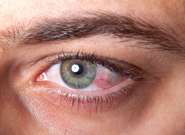 Mata Merah (Konjungtivitis) – Penyebab, Gejala, Diagnosis, Pengobatan & Pencegahan