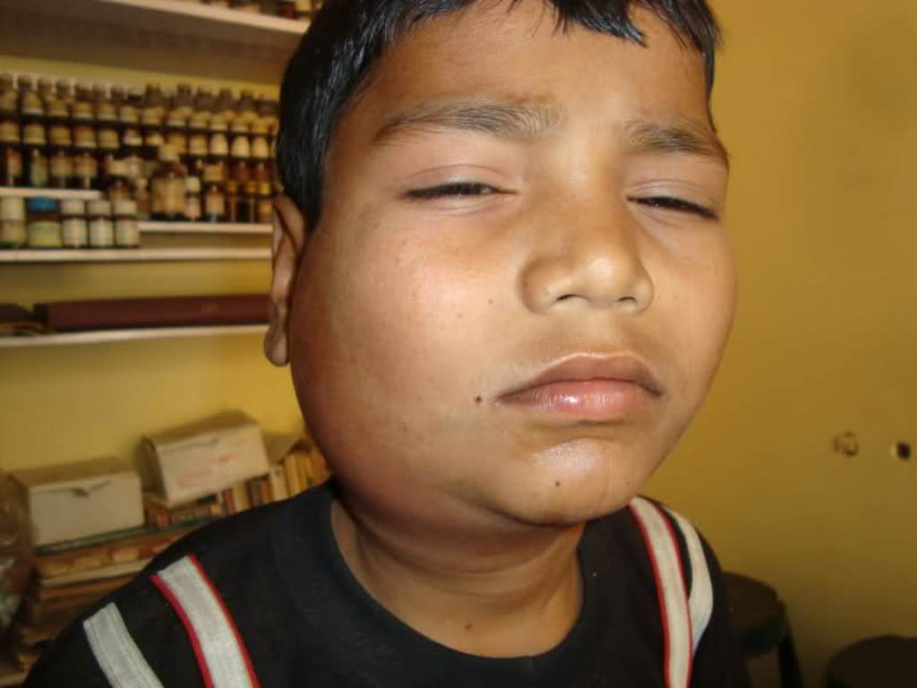 Mengenali Gejala Penyakit Mumps (Gondong) hingga Pengobatan