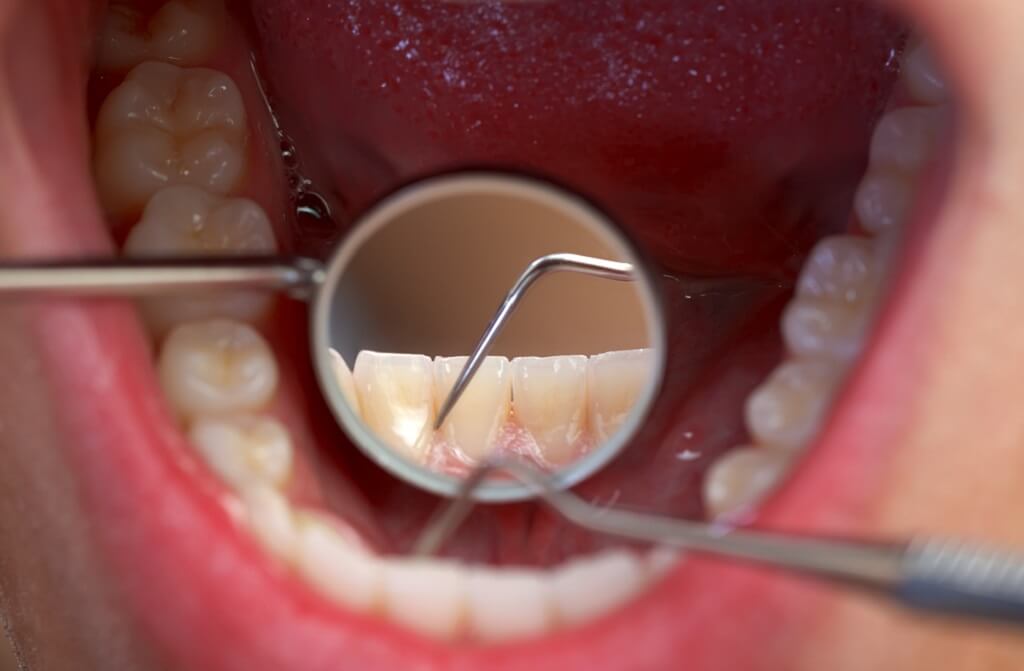 Cara Menghilangkan dan Mencegah Terjadinya Karang Gigi