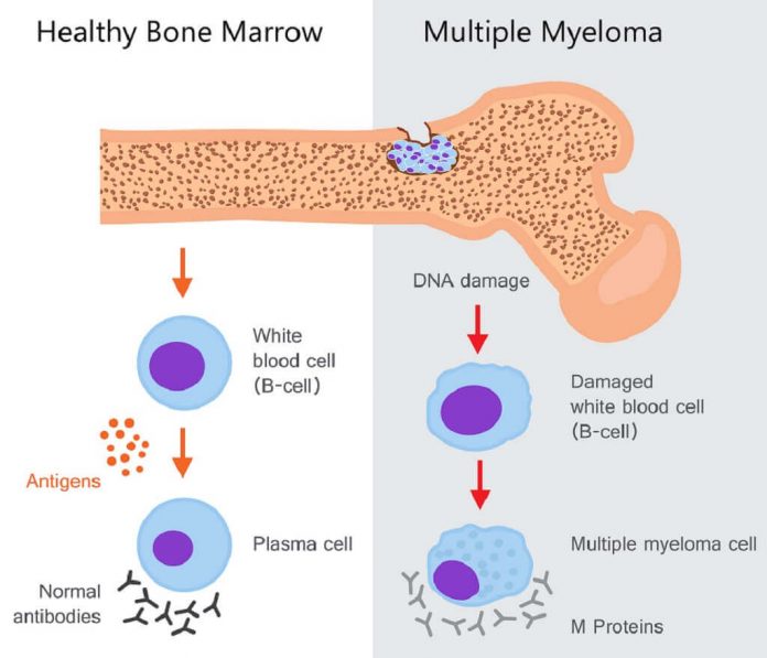 multiple-myeloma-doktersehat