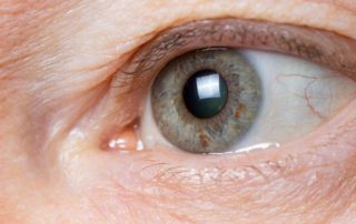 Kanker Mata Melanoma: Gejala, Penyebab, Diagnosis, dan Pengobatan