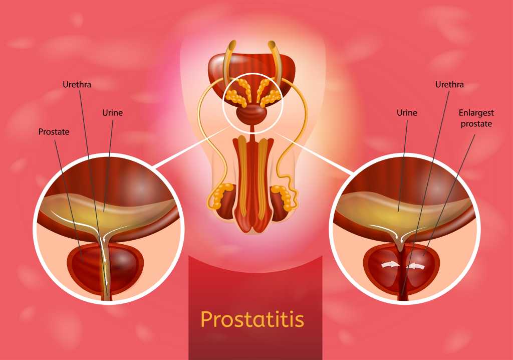 Mi történik éles prosztatitis