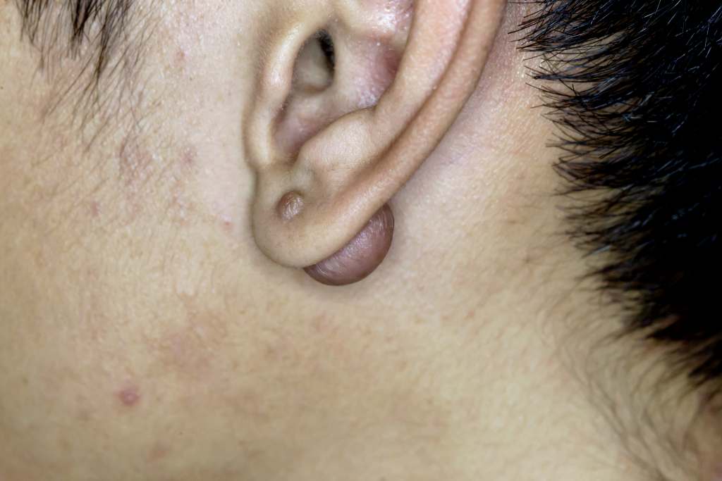 7 Penyebab Benjolan di Belakang Telinga dan Cara Mengatasinya