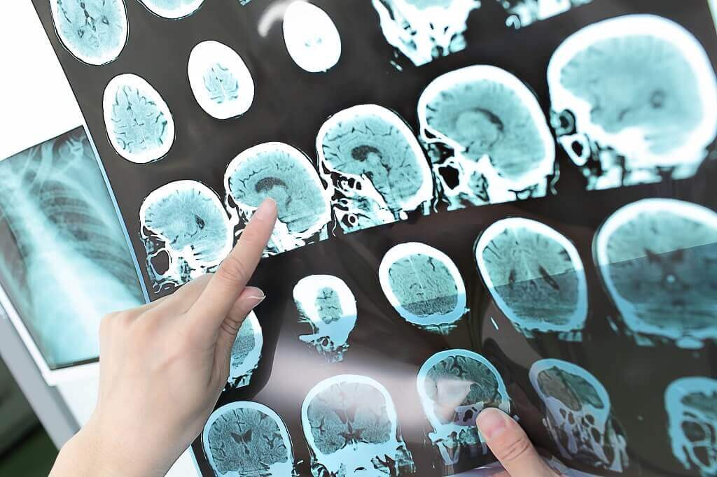 Tumor Otak: Gejala, Penyebab, Diagnosis, dan Pengobatan