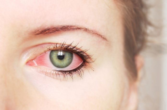 doktersehat-mata-merah-kurang-vitamin-C-bakteri-glaukoma-Eksoftalmus-1024