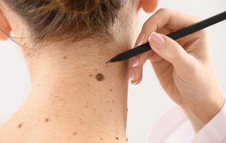 Mengenali Perbedaan Tahi Lalat Normal dengan Kanker Melanoma