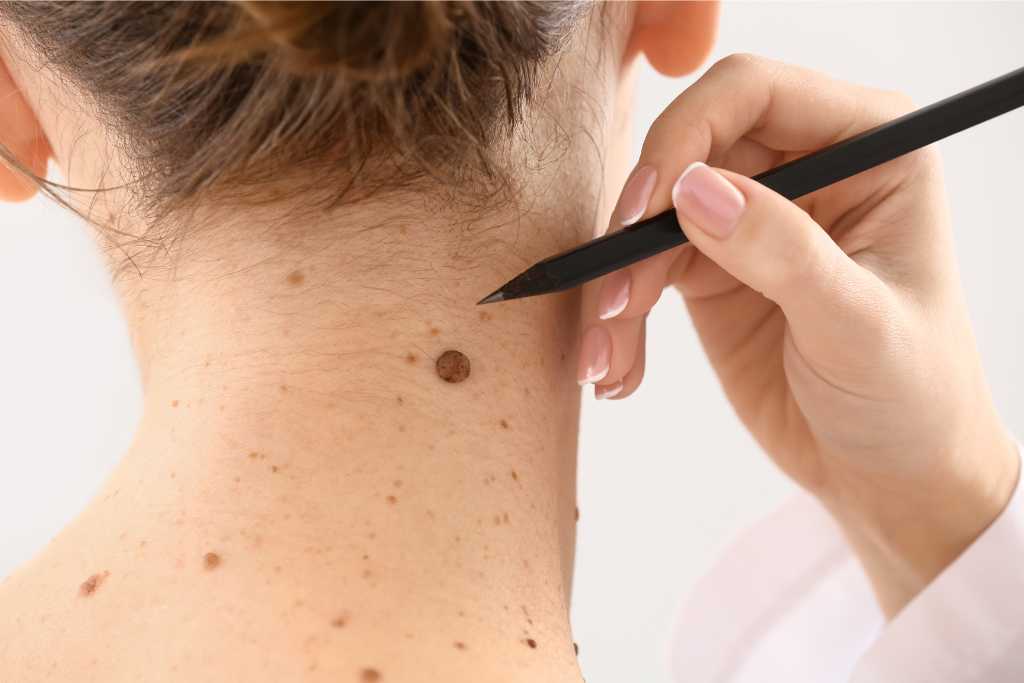 Mengenali Perbedaan Tahi Lalat Normal dengan Kanker Melanoma