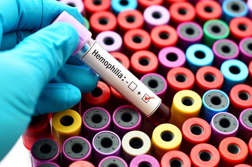 Mengenali Berbagai Penyebab Hemofilia pada Tubuh Anda