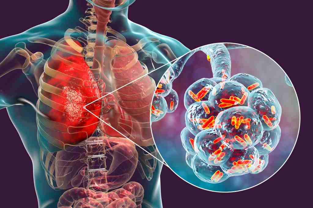 Pneumonia Aspirasi: Gejala, Penyebab, Diagnosis, dan Pengobatan