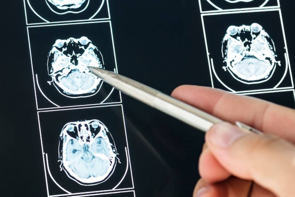 Mengenal Stadium Kanker Otak, Mulai dari Tahap Awal hingga Akhir