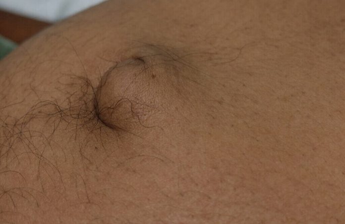 hernia-umbilikalis-doktersehat