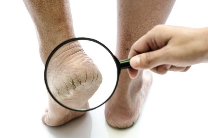 telapak-kaki-pecah-doktersehat_232604116