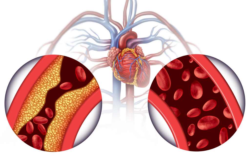 Penyakit Jantung Koroner: Gejala, Penyebab, Cara Mengobati, dll