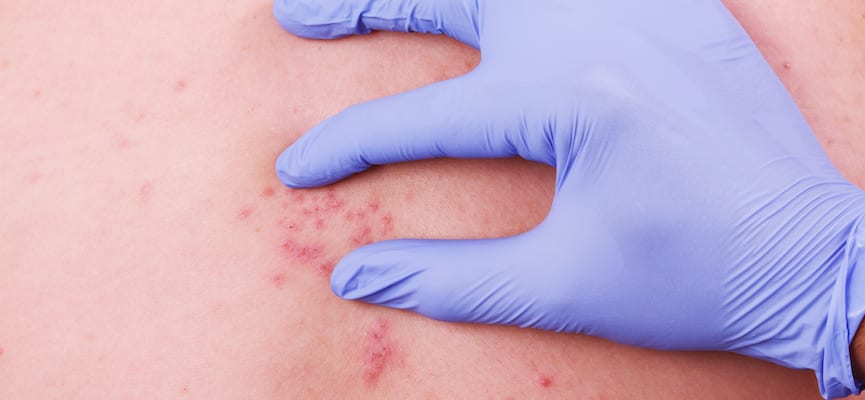 Mengenal Penyakit Herpes Zoster Pada Lansia