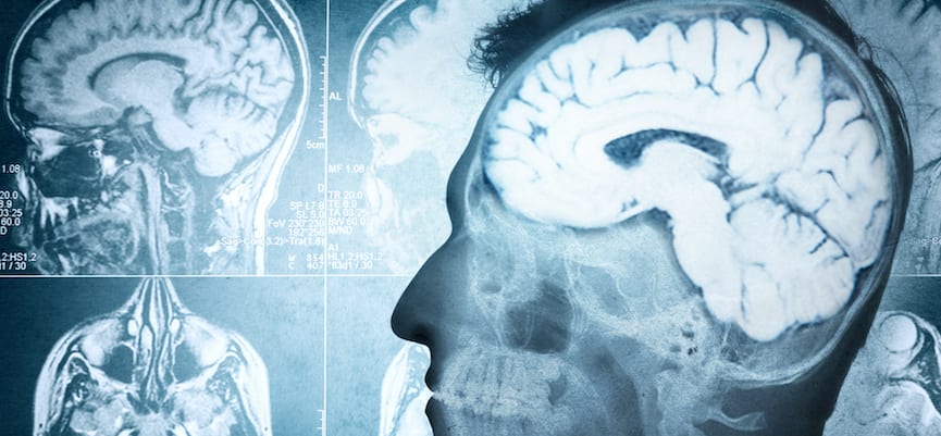 Infeksi Otak – Pengertian, Penyebab, dan Pengobatan