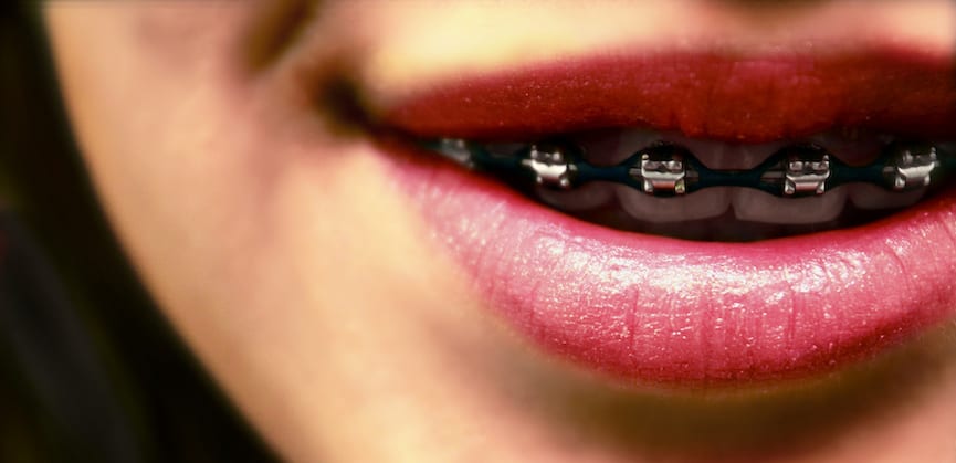 Beberapa Dampak Negatif Penggunaan Kawat Gigi Yang Perlu Diketahui