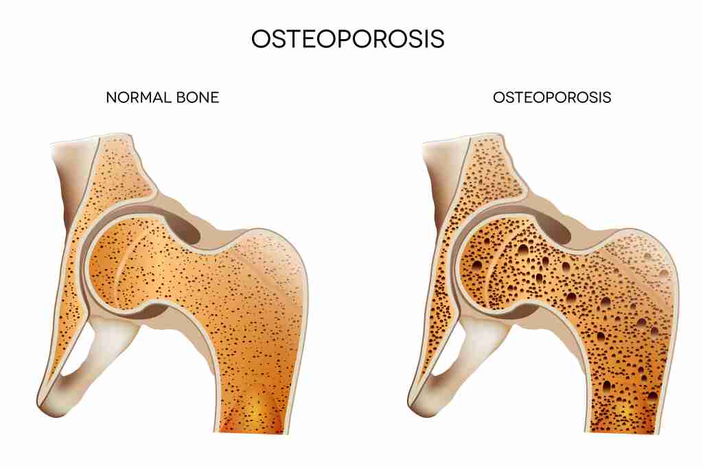 Osteoporosis: Gejala, Penyebab, Diagnosis, dan Pengobatan