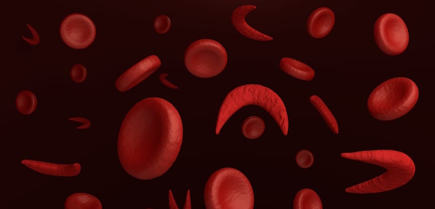 Mengenal Lebih Baik Penyakit Thalasemia yang Memicu Kelainan Sel Darah Merah