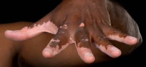doktersehat-vitiligo-hiperpigmentasi-Hipopigmentasi