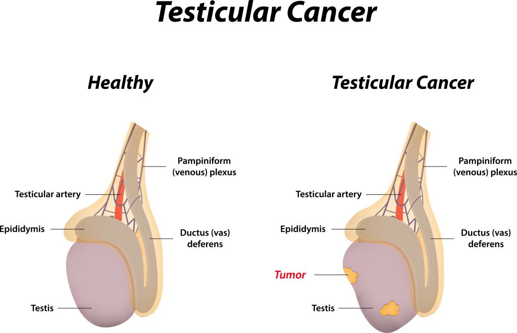 Kanker Testis: Gejala, Penyebab, Diagnosis, dan Pengobatan