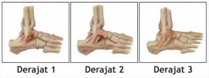 klasifikasi cedera ankle