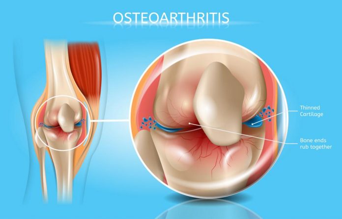 osteoarthritis-adalah-doktersehat