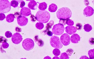 Chronic Myelogenous Leukemia (CML): Gejala, Penyebab, dan Pengobatan