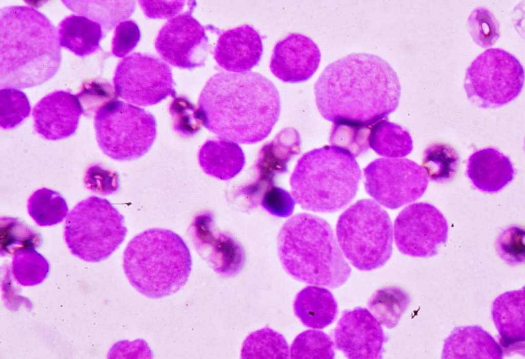 Penyebab leukemia