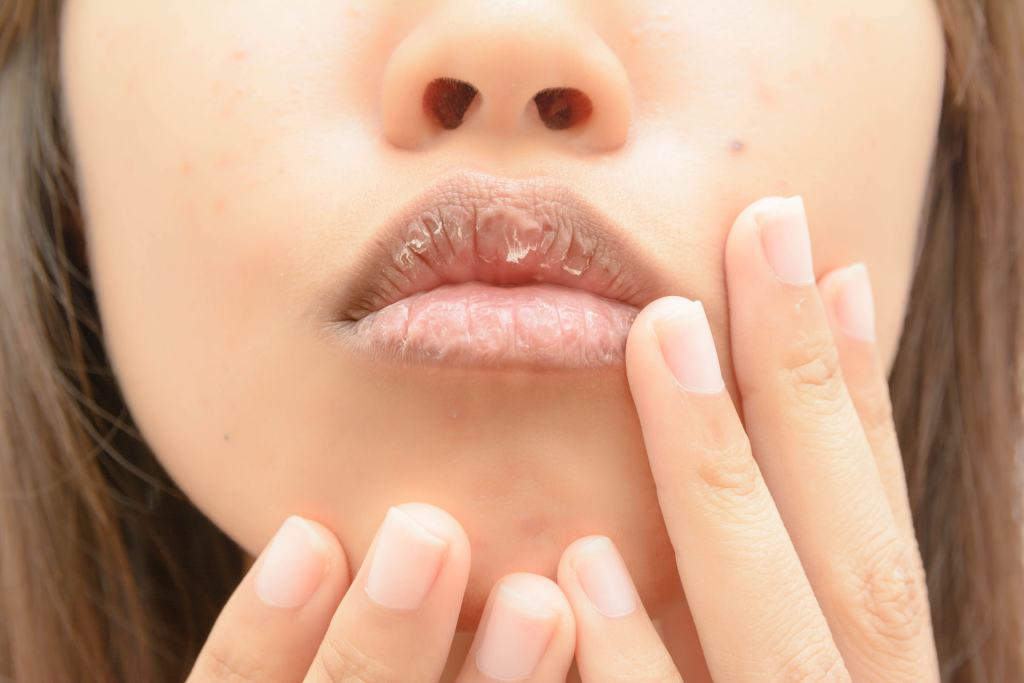 11 Penyebab Bibir Kering & Pecah-Pecah (No. 8 Tak Disangka)