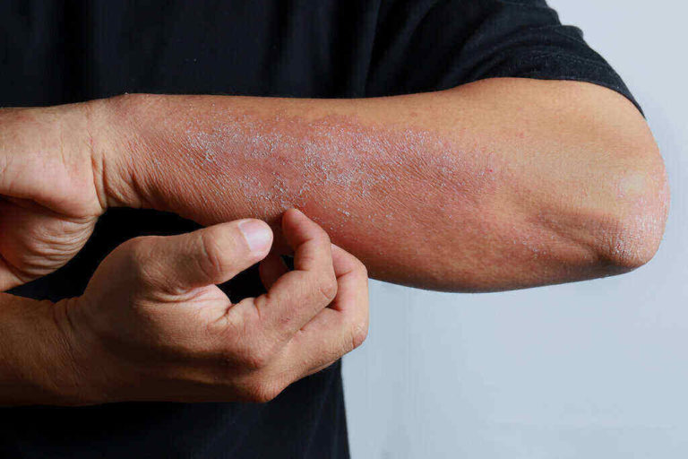 Macam-Macam Dermatitis Yang Harus Diwaspadai - DokterSehat