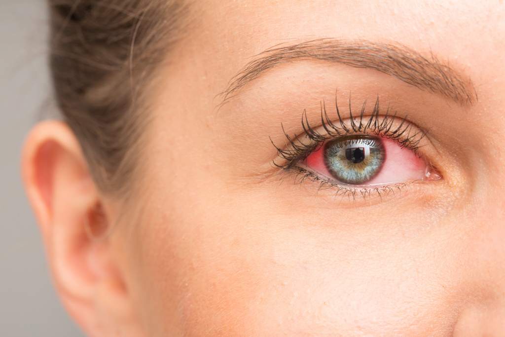 Mata Kering: Penyebab, Gejala, Diagnosis, dan Pengobatan
