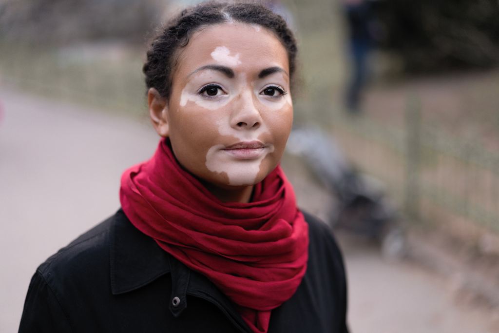 Vitiligo: Penyebab, Gejala, Komplikasi, dan Pengobatan