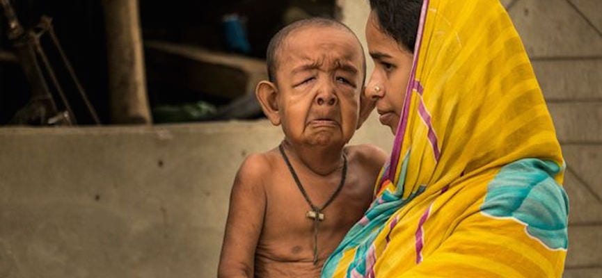 Balita dari Bangladesh Terkena Penyakit yang Membuatnya Seperti Kakek-Kakek
