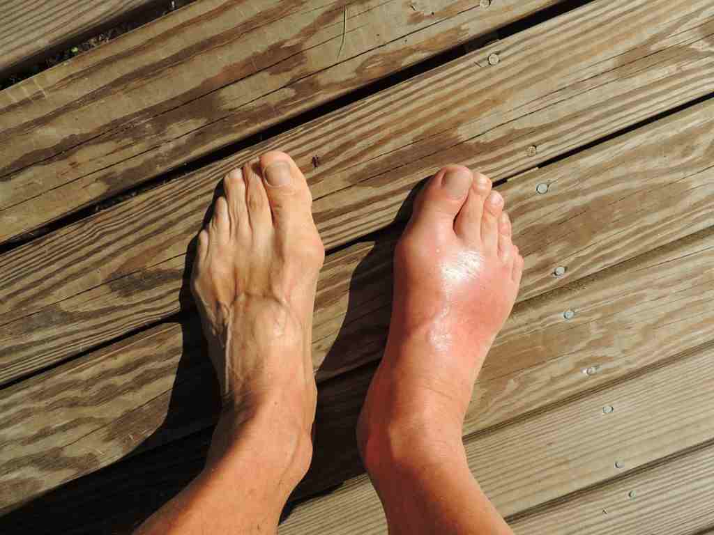 Gout Arthritis: Gejala, Penyebab, dan Pengobatan