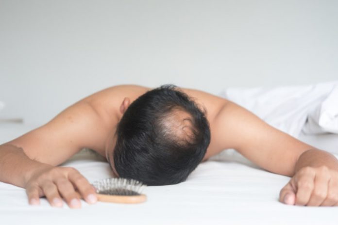 alopecia-doktersehat