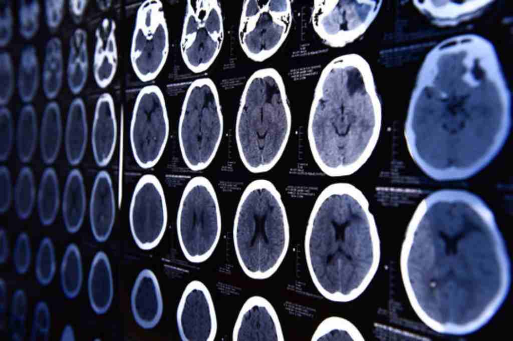 Lesi Otak: Jenis, Gejala, Penyebab, hingga Pengobatan