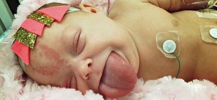 Bayi Ini Terlahir Dengan Kondisi Macroglossia Sehingga Memiliki Lidah Dengan Ukuran Sangat Besar