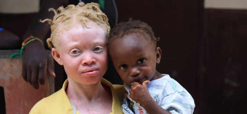 Desa di Tanzania Ini Dipenuhi Oleh Penderita Albino