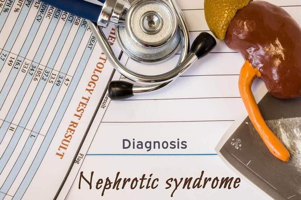 Sindrom Nefrotik: Gejala, Penyebab, Diagnosis, dan Pengobatan