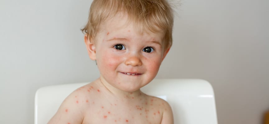 Imunisasi untuk Anak – Cacar Air dan Hepatitis A